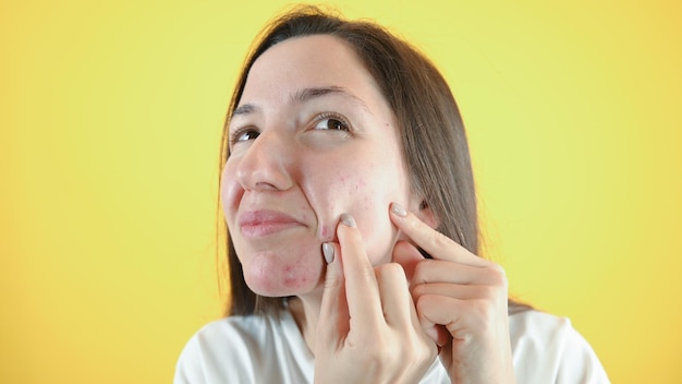 Ritratto di donna bruna triste che si tocca il viso e cerca l'acne Acne spot brufolo spot skincare bellezza cura ragazza premendo sul problema della pelle viso Foto di alta qualità