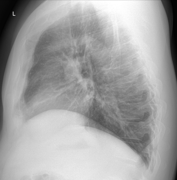Scansione a raggi X del polmone del fumatore maschio senza modificare la vista laterale con indurimento probabilmente patologico