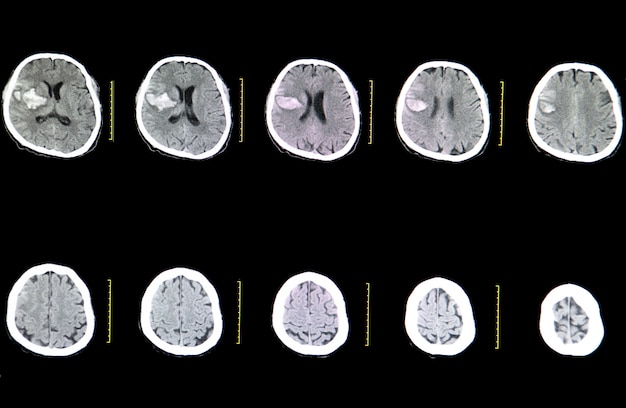 Scansione cerebrale CT di un paziente colpito da ictus