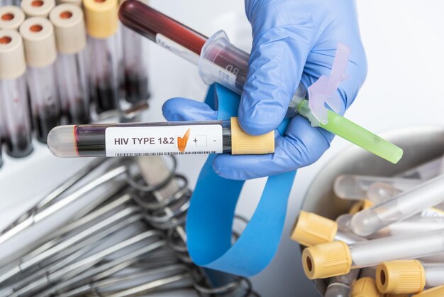 Scienziati in mano con un tubo di prova con un campione di sangue per il test HIV tyoe 1 e 2