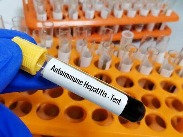 Scienziato che detiene un campione di sangue per il test dell'epatite autoimmune con background di laboratorio