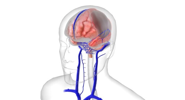 Se si verifica un trauma cranico, un aumento dello stress sulle vene a ponte può causarne la lacerazione