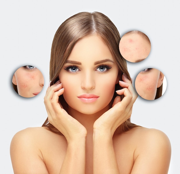 Segni post-acne Trattamento delle cicatrici da acne Rimozione della cicatrice da acne