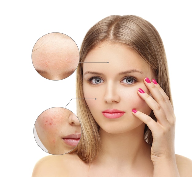 Segni post-acne Trattamento delle cicatrici da acne