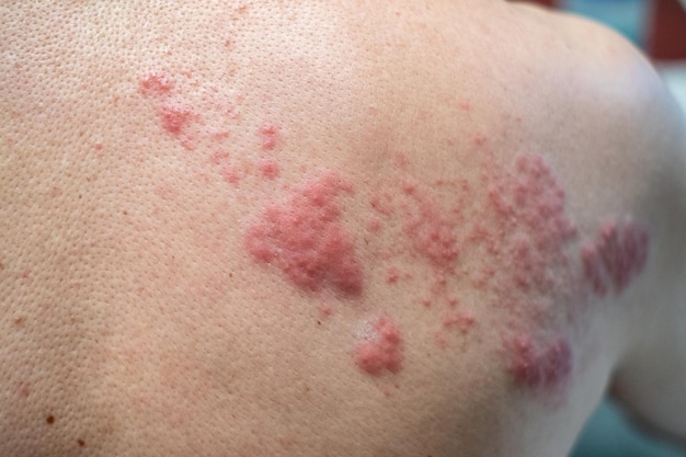 Shingles Disease Herpes zoster virus varicellazoster rash cutaneo e vesciche sul corpo