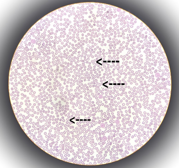 Stomatociti analizzati al microscopio. I globuli rossi sono a forma di fessura, pallore centrale della bocca di pesce.