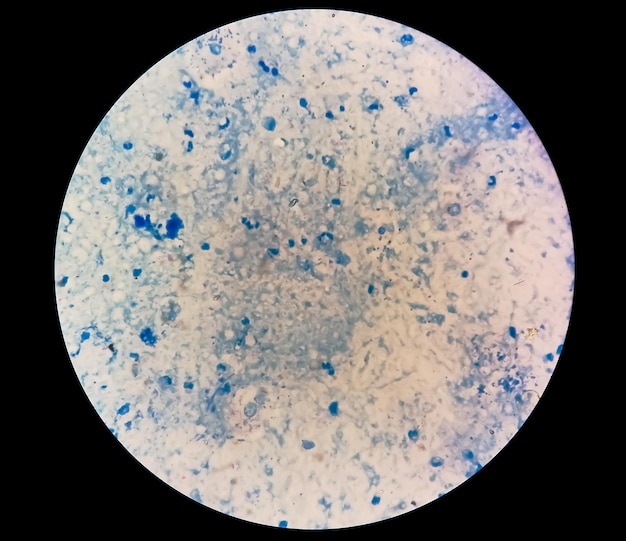 Striscio di espettorato al microscopio che mostra cocchi gram-positivi