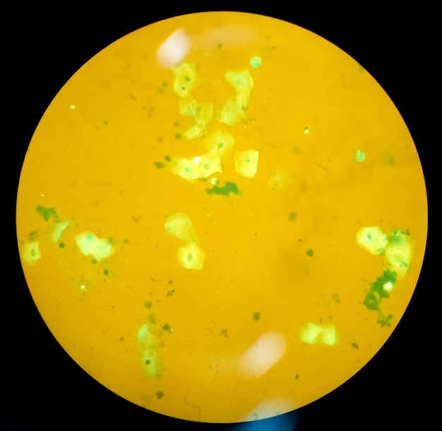 Striscio di espettorato o catarro AFB, auramina O e LED colorato fluorescente Cellula epiteliale al microscopio