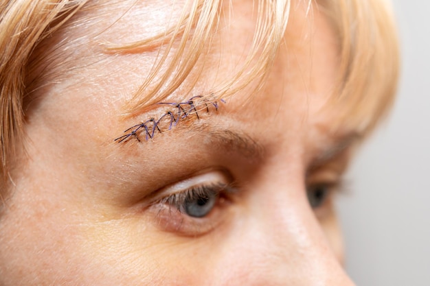 sutura medica con fili sporgenti su un viso di donna vicino al sopracciglio, primo piano