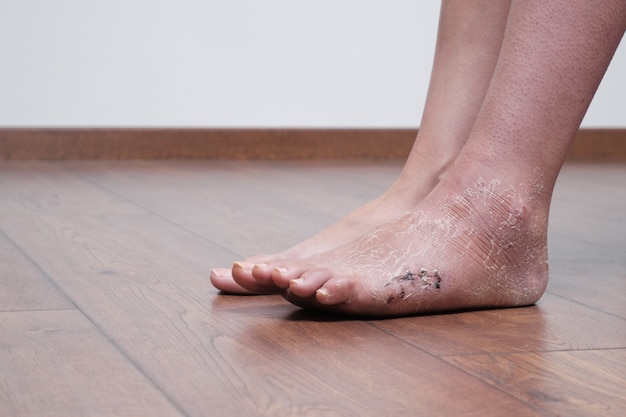 Sutura postoperatoria sul piede, sulla gamba dopo la frattura e dopo la rimozione del bendaggio in gesso