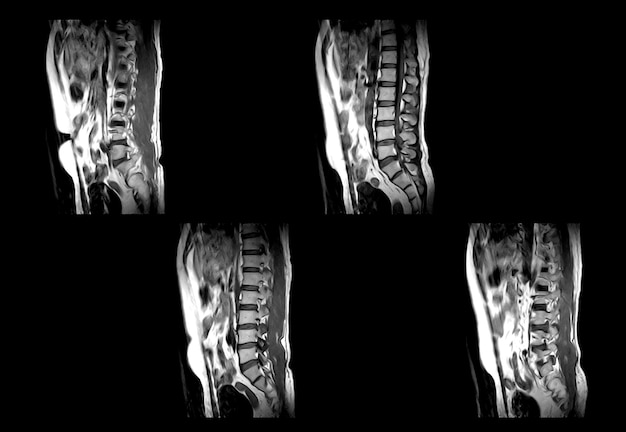 TAC della colonna vertebrale inferiore e immagini professionali MRI