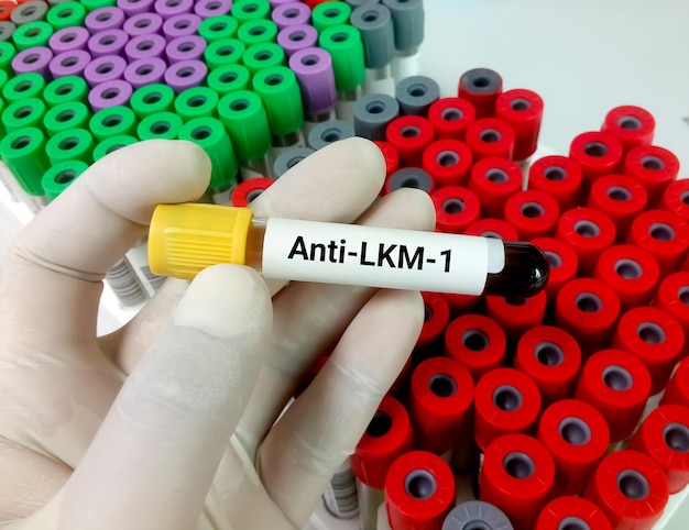 Test anti-fegato renale microsomiale 1 o anti LKM1 per la diagnosi di epatite autoimmune