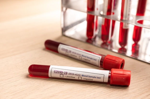 Test del campione di sangue COVID-19, 2019-nCoV Coronavirus check-up in laboratorio