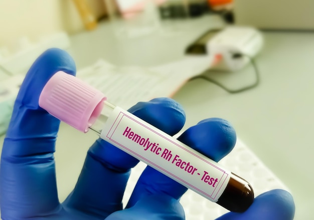 Test del sangue di incompatibilità Rh noto anche come test del fattore Rh emolitico o test della malattia remolitica