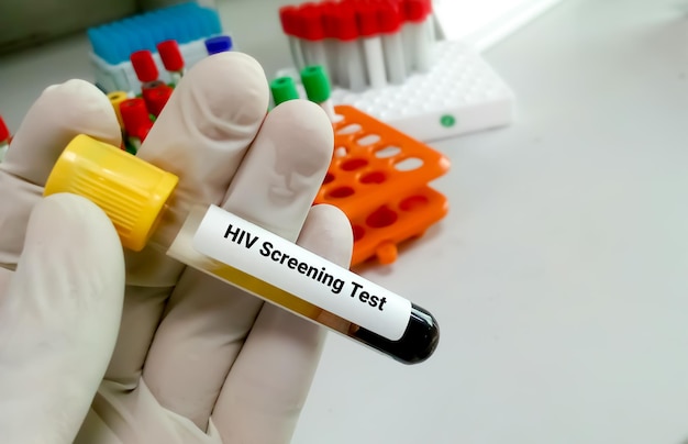 Test di screening dell'HIV per diagnosticare l'infezione da HIV