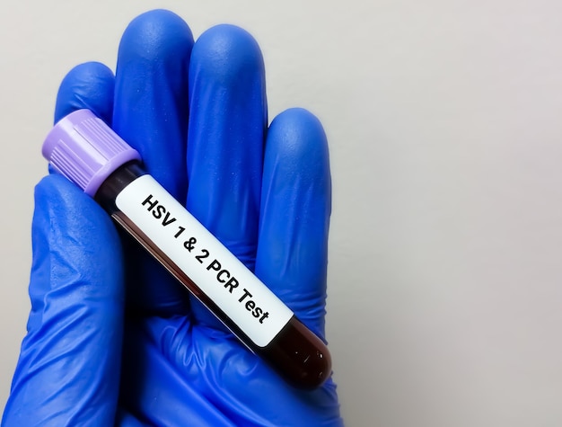 Test PCR HSV 1 e 2 del campione di sangue per rilevare l'infezione da virus Herpes simplex