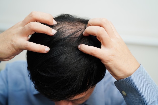 Testa calva nell'uomo trattamento della perdita dei capelli problema di salute