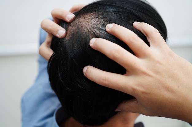 Testa calva nell'uomo trattamento della perdita dei capelli problema di salute