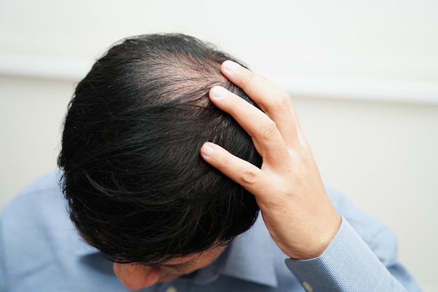 Testa calva nell'uomo trattamento della perdita dei capelli problema di salute