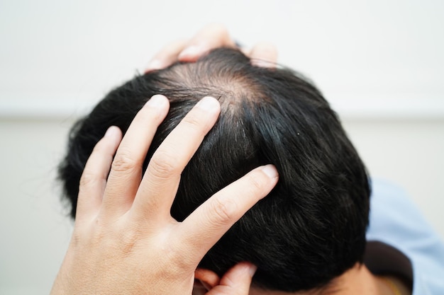 Testa calva nell'uomo trattamento della perdita di capelli problema di salute