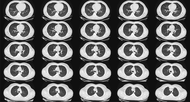 Tomografia computerizzata dei polmoni in un uomo adulto sano TAC polmoni normali Può far parte della diagnostica COVID19