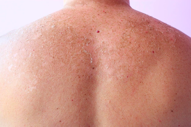 Tracce di scottature sulla schiena di un uomo Pelle umana dopo aver preso il sole