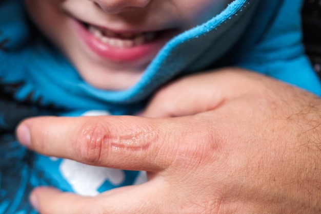 Traccia di denti che mordono sulla pelle Cattivo comportamento del bambino