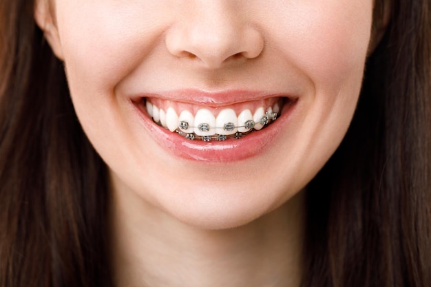 Trattamento ortodontico concetto di cura dentale bella donna sorriso sano primo piano primo piano ceramica e