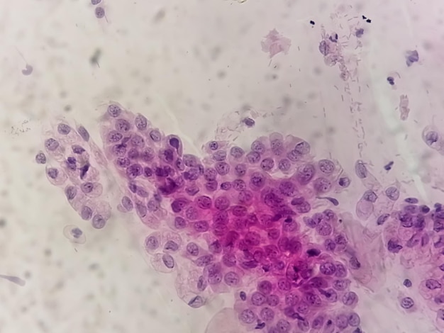 Trichomonas vaginalis nel pap test con poche cellule infiammatorie acute. Tricomoniasi. malattie sessualmente trasmissibili