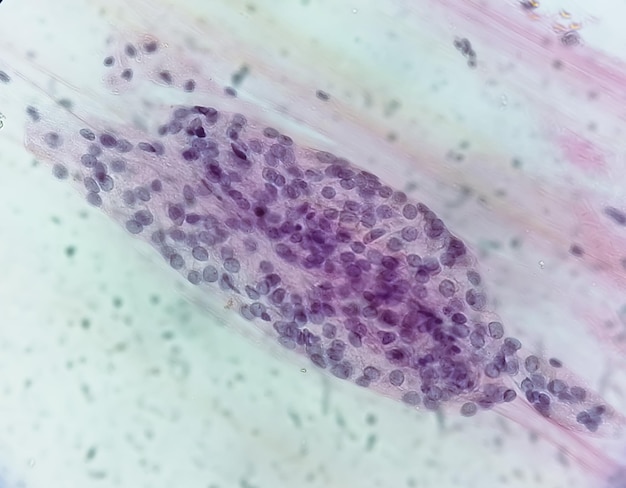 Trichomonas vaginalis nel pap test con poche cellule infiammatorie acute. Tricomoniasi. malattie sessualmente trasmissibili