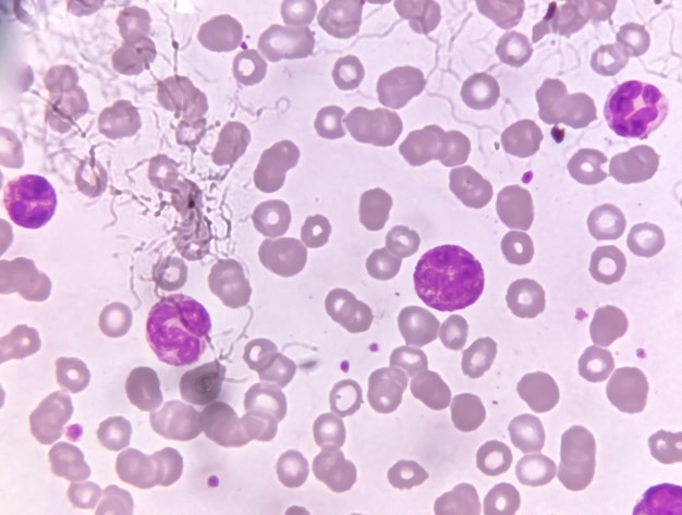 Trombocitopenia acuta e leucocitopenia. Primo piano Micrografia del paziente con febbre da virus dengue in laboratorio.