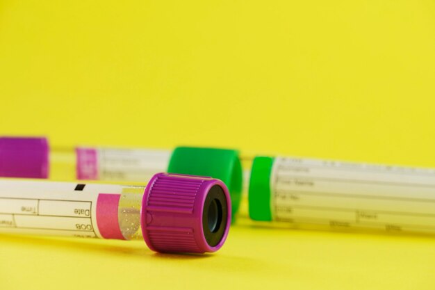 Tubi sottovuoto per la raccolta e campioni di sangue su sfondo giallo. Trasparente con coperchio viola e verde. Etichetta per identificare i dati. Messa a fuoco selettiva.