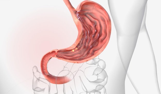Ulcere gastriche ulcere gastriche sono piaghe aperte che si sviluppano sul rivestimento dello stomaco