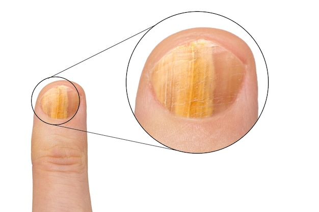 Un cerchio ingrandito rivela un'unghia gialla e fragile su una persona scolorimento del dito e ispessimento dell'unghia sintomatica di onicomicosi un'infezione fungina