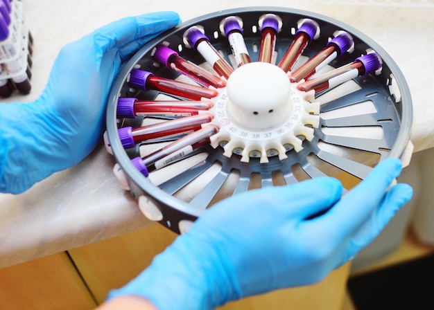 Un medico o un tecnico PCR in un laboratorio batteriologico detiene una centrifuga con campioni di sangue in provette.2019-nCoV; coronavirus; Cina;