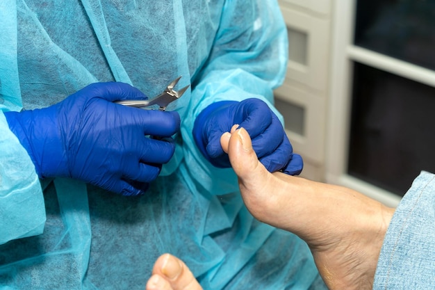 Un medico sta usando una lima per unghie per tagliare la punta di un piede