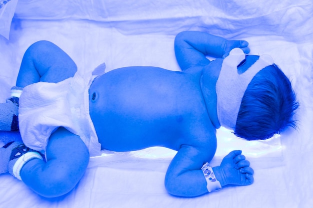 Un neonato giace sotto le lampade ultraviolette sotto la luce blu Trattamento della bilirubina elevata dell'incubatrice ultravioletta dell'ittero infantile