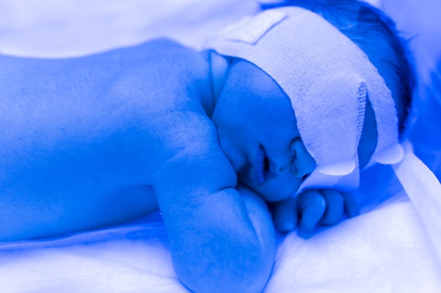 Un neonato giace sotto le lampade ultraviolette sotto la luce blu Trattamento della bilirubina elevata dell'incubatrice ultravioletta dell'ittero infantile