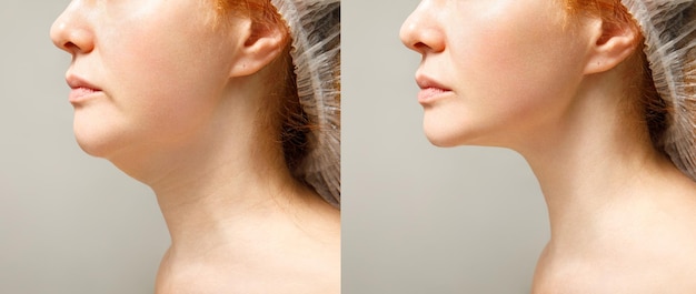 Un ritratto ravvicinato di una donna anziana prima e dopo la procedura di ringiovanimento facciale Correzione della forma del mento Liposuzione del collo Il risultato della procedura nella clinica di medicina estetica