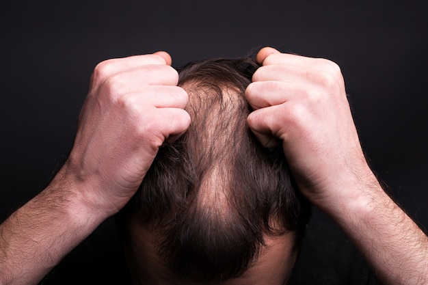 Un uomo gli afferra i capelli. Testa con calvizie. Il problema della crescita dei capelli sulla testa.