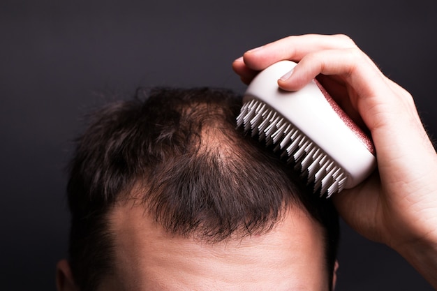 Un uomo si sta pettinando i capelli. Testa con calvizie. Il problema della crescita dei capelli sulla testa.