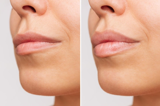 Un volto di giovane donna con le labbra prima e dopo il miglioramento delle labbra Iniezione di filler nelle labbra