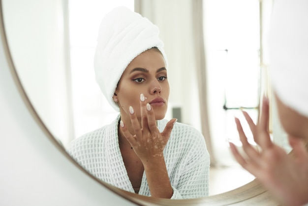 Una bella giovane donna con la vitiligine sulle mani si applica una crema per la pelle problematica sul viso