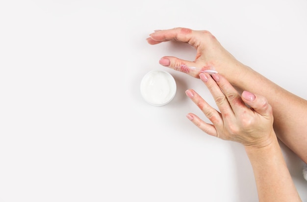 Una donna applica la crema sulle mani per trattare la dermatite