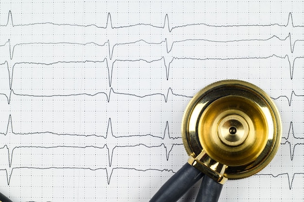 Uno stetoscopio e un elettrocardiogramma registrato con extrasistoli sopraventricolari giacciono su un tavolo nell'ufficio di un cardiologo