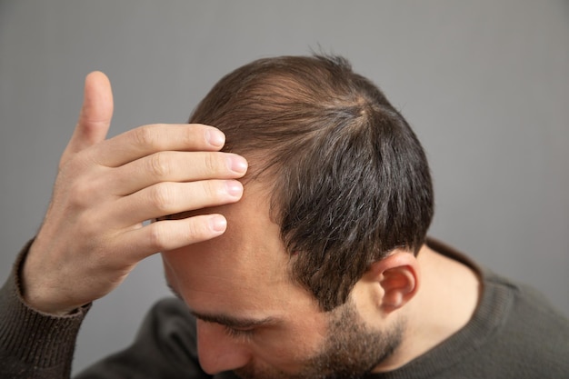 Uomo caucasico Problema di perdita di capelli