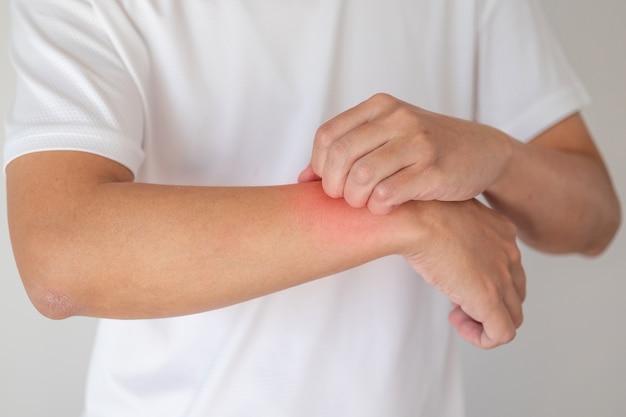 Uomo che prude e gratta il braccio a causa di pelle secca pruritiva eczema dermatite