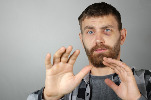 Uomo con un vero livido agli occhi