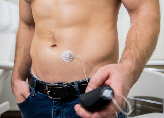 Uomo diabetico con una pompa per insulina collegata all'addome e che mantiene la pompa per insulina