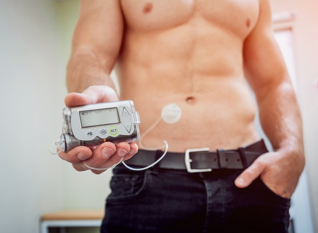 Uomo diabetico con una pompa per insulina collegata all'addome